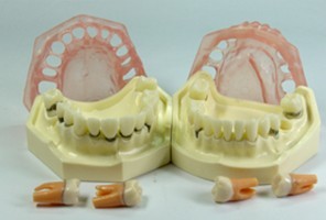 <b>牙周病模型</b>