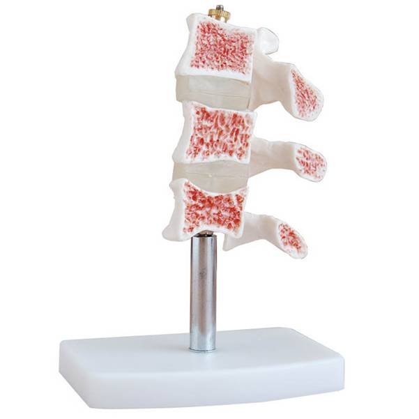 <b>骨质疏松模型(脊椎典型病变模型)</b>